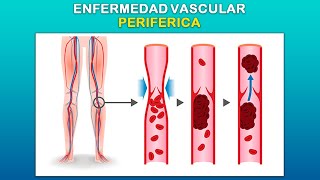 Enfermedad vascular periférica  Tu Salud Tu Familia [upl. by Sussi]