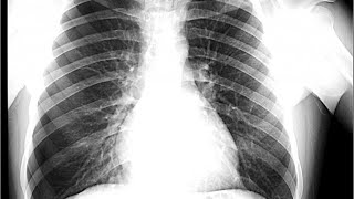 Semiologia  Síndromes pleuropulmonares [upl. by Ecined725]