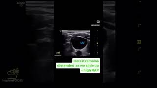 Estimating RA pressure using internal jugular vein ultrasound part 2  POCUS  Dr Koratala shorts [upl. by Carper112]