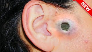 Top 10 videos to remove Monster blackheads on Ear Nose and Face 01 [upl. by Corinne]