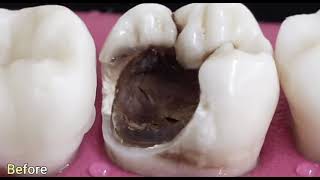 Root canal treatment procedure and a gold crown [upl. by Arah]