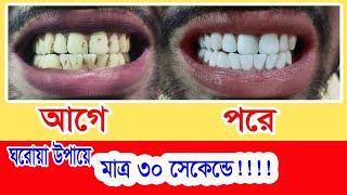 হলুদদাঁতসাদাকরারউপায় ।। dater kalo dag dur korar upay ।। Easy way to whiten teeth ।। [upl. by Kathie354]