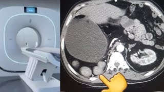 spleen examination POLYSPLENIA on ct scan [upl. by Enel578]