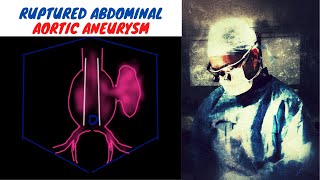 Ruptured Abdominal Aortic Aneurysm [upl. by Selassie]