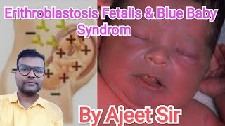 Erithroblastosis Fetalis and Blue baby syndrom By Ajeet Sir [upl. by Cyrille272]