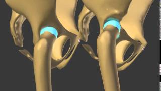 subluxation hip dysplasia developmental neo acetabulum build [upl. by Fiann392]