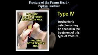 Fractures Of The Femur Head Pipkin Fracture  Everything You Need To Know  Dr Nabil Ebraheim [upl. by Zahavi989]