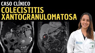 Caso clínico 110 Colecistitis xantogranulomatosa [upl. by Sascha]