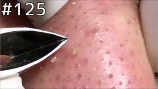 角栓 除去 blackheads removal 125 [upl. by Illib231]