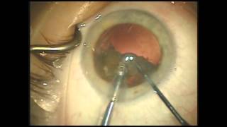 Comparing foot pedal control during cataract surgery [upl. by Doig]