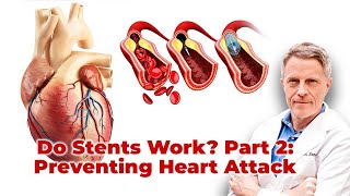 Do Stents Work Part 2 PreventingHeart Attack nope [upl. by Halehs156]