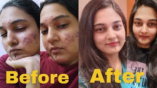 MY ACNE JOURNEY  MY EXPERIENCE WITH ISOTRETINOIN  HOW I CLEARED MY ACNE  USE OF TRETINOA005 [upl. by Akedijn234]