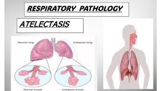 Respo pathology  ATELECTASIS and its types atelectasis copd pathology [upl. by Shum669]