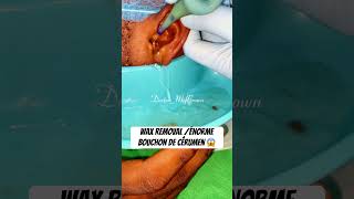 extraction d’un énorme bouchon de cérumen  bain d’oreille 😱 reels wax viralvideo viralshorts [upl. by Poppy]