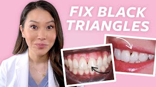 FIX Gaps in Teeth  How to Close Black Triangles [upl. by Gillan]