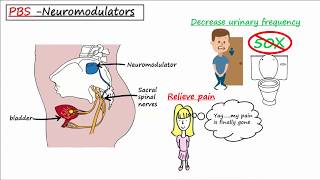 Painful Bladder Syndrome PBS  Interstitial Cystitis IC [upl. by Dnomyar]