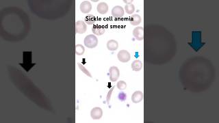 Sickle cell anemia under microscope Blood smear hematology Hematopathology worldsicklecellday [upl. by Tloc]