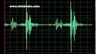 Right Bundle Branch Block slow [upl. by Noel]