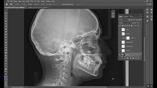 Orthognathic Surgery Part 2 المرحلة الخامسة [upl. by Werdnaed]