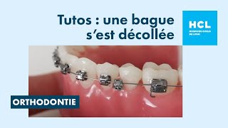 Que faire si une bague orthodontique se décolle   Urgence orthodontie [upl. by Neelrahs]