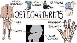 Understanding Osteoarthritis [upl. by Annat]