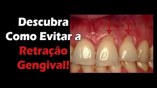 Como Evitar a Retração Gengival – 8 Super Dicas Caseiras QUE FUNCIONAM [upl. by Enyaz861]