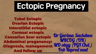 Ectopic pregnancy diagnosis management and follow up plan [upl. by Meehyrb]