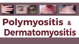 A Simplified Overview of Polymyositis amp Dermatomyositis  Clinical Features Diagnosis amp Treatment [upl. by Athallia]