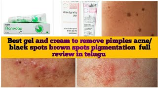 Best solution for pimples acne gelblack spots brown spots pigmenting creamAcnedapDepiwhite review [upl. by Nilyad]