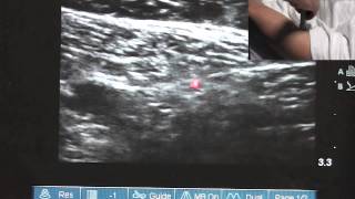 Ultrasound Guided Saphenous Nerve Block  SSRAUSAcom [upl. by Nodyarg]