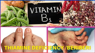 BeriBeri  Thiamine deficiency [upl. by Gellman]