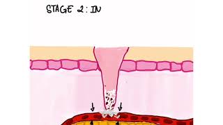 4 STAGES OF WOUND HEALING PROCESS [upl. by Fronniah]