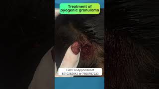 Treatment of pyogenic granuloma  By Dr Uttam Kumar Lenka MBBS MD Consultant Dermatologist [upl. by Atilegna924]