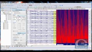 MicroMagLink Online amp Offline Artifact Suppression [upl. by Elocon]