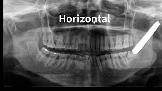 2 min noodle technique  quotThe Lingual Splitquot for 3rd Molar Disimpaction Advised Viewer discretion [upl. by Abba]