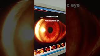 pseudophakia  ophthalmology case [upl. by Sundberg479]