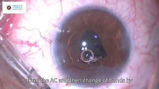 Subluxated Traumatic Mature Cataract  Iris Claw Lens  MEHRC  Dr Ashish K Jain [upl. by Derej]