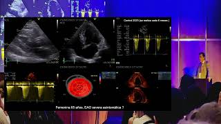 Estenosis Aortica Asintomatica Cuando pienso en Intervenir [upl. by Novj]