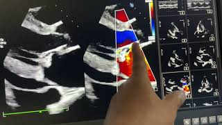 Papillary Fibroelastoma of PML How to differentiate pleural from pericardial effusion [upl. by Casavant]