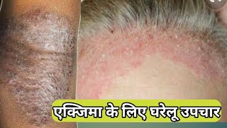 eczema ka ilaajeczema treatment in hindi [upl. by Launame]