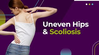 Uneven Hips and Scoliosis [upl. by Enel]