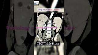 cect triple phase  ct triple phase [upl. by Tuck]