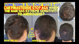 Long term 8 yrs Can finasteride stop AGA when the hair has extreme sensitivity to androgens2015 [upl. by Ailahs]