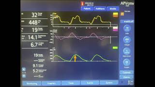 Ventilator Asynchrony Delayed Cycling [upl. by Doane]