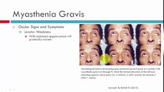 Myasthenia Gravis Clinical Characteristics [upl. by Einnaej371]