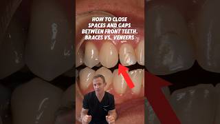 How to close spaces and gaps between front teeth Braces vs veneers dentist wichita veneers [upl. by Ikcim730]