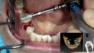 drGiampiero Ciabattoni Digital Implantology Video Channel AlphaBio Tec Dental Implants [upl. by Thierry938]