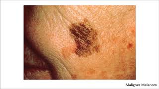 Dermatologie Blickdiagnosen  Krankheitsbilder [upl. by Mehsah]