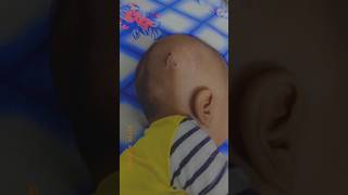 Hydrocephalus shunt surgery stitches recovery alhamdulillah [upl. by Hsivat]