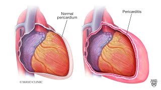 Mayo Clinic Minute What is pericarditis [upl. by Tedmann]